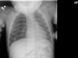 1 pediatric x ray